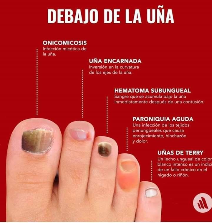 Parche Anti Hongo Uña - Original